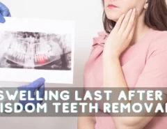 How Long Does Swelling Last After Wisdom Teeth Removal