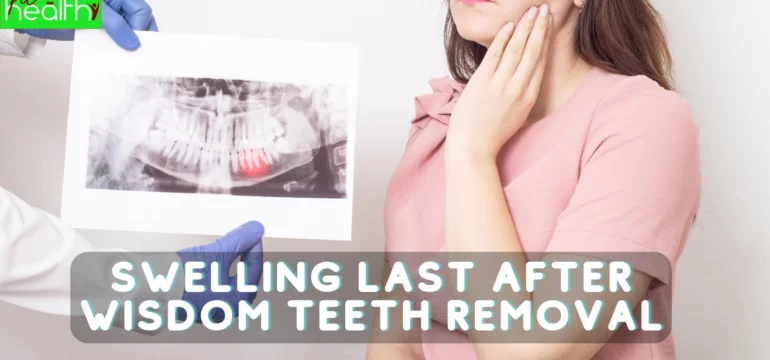 How Long Does Swelling Last After Wisdom Teeth Removal